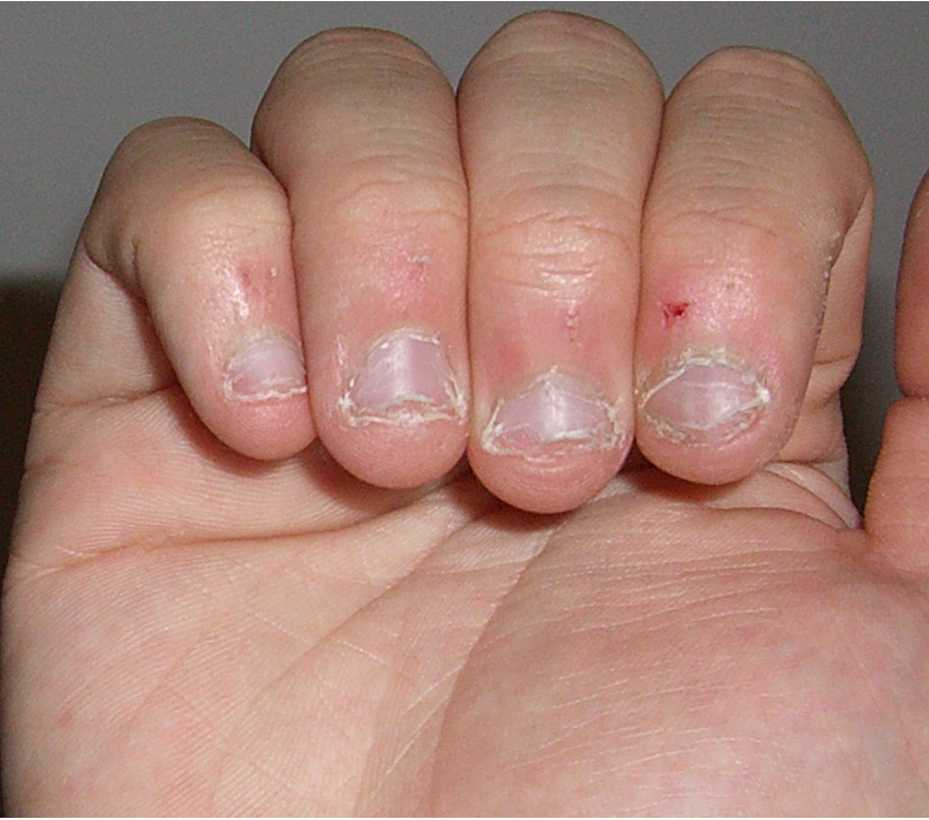 nail biting