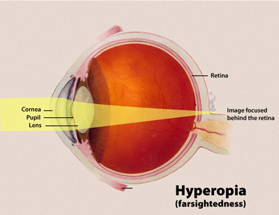 visual impairment
