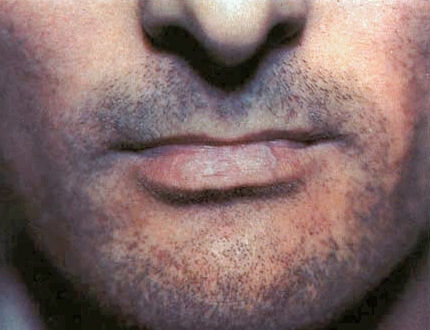 lichen planus