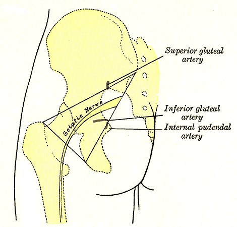 sciatica