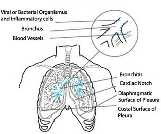 bronchitis