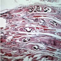 trichinosis