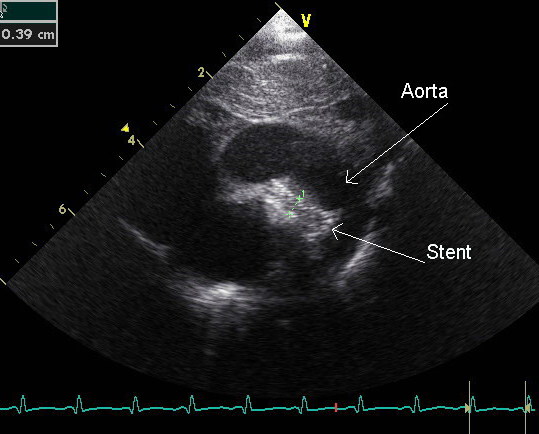 stent