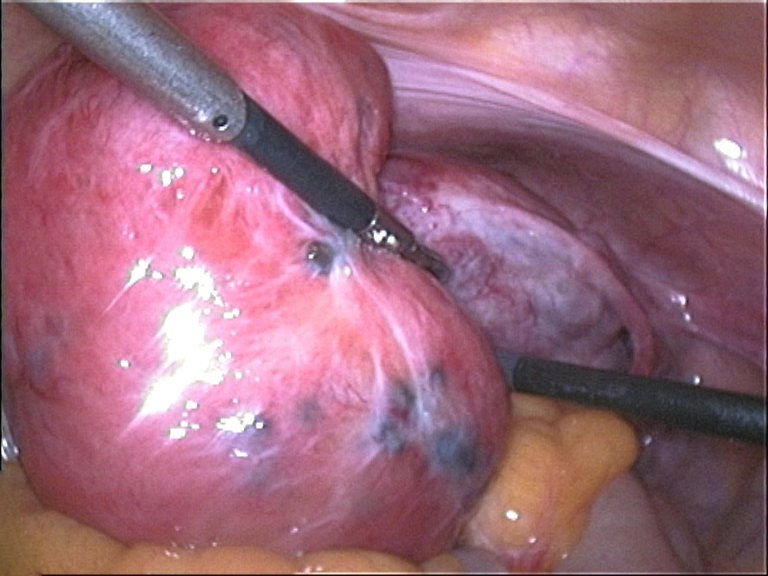 adenomyosis