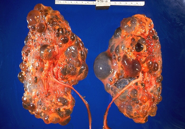 autosomal dominant polycystic kidney