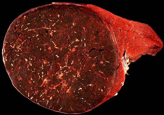 hamartoma