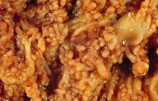 ulcerative colitis