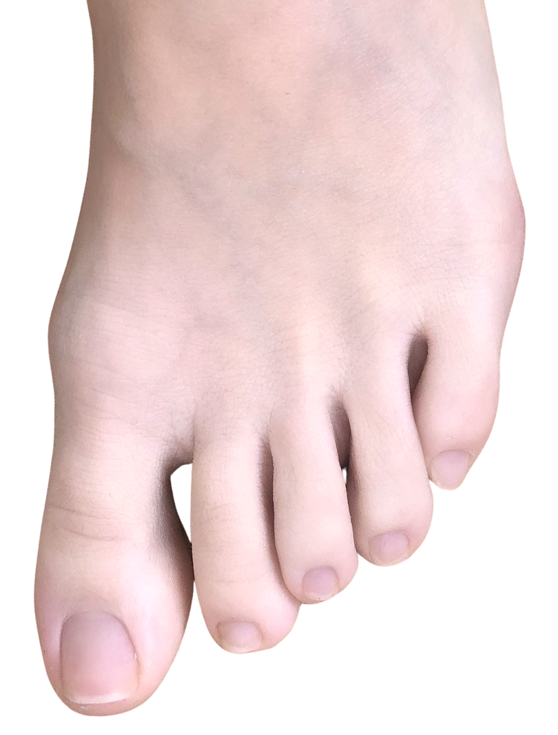 hallux