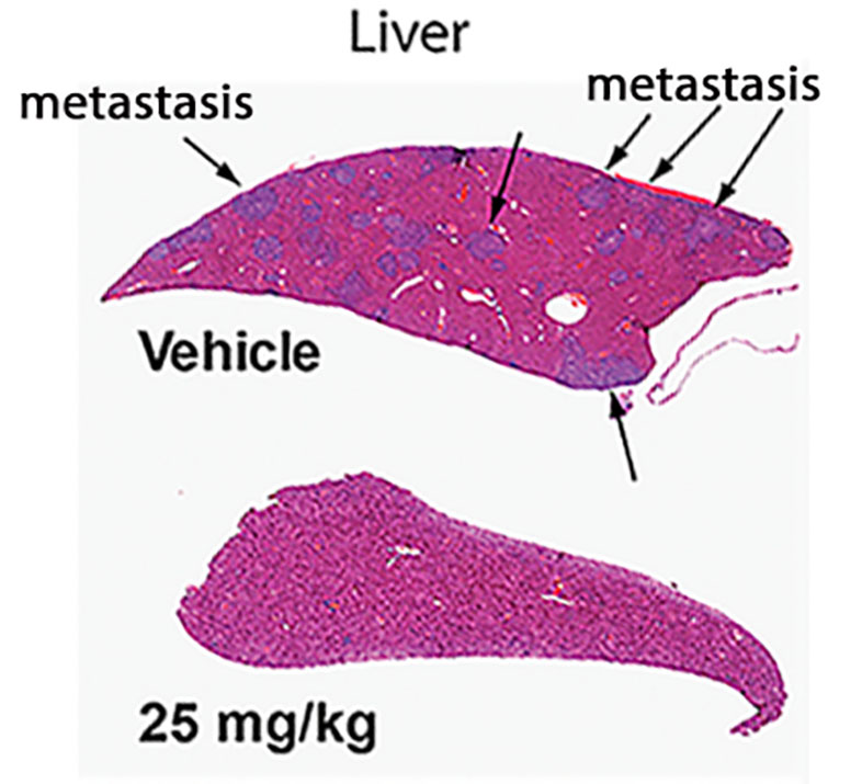 liver cancer
