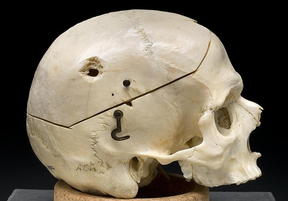 gunshot wound