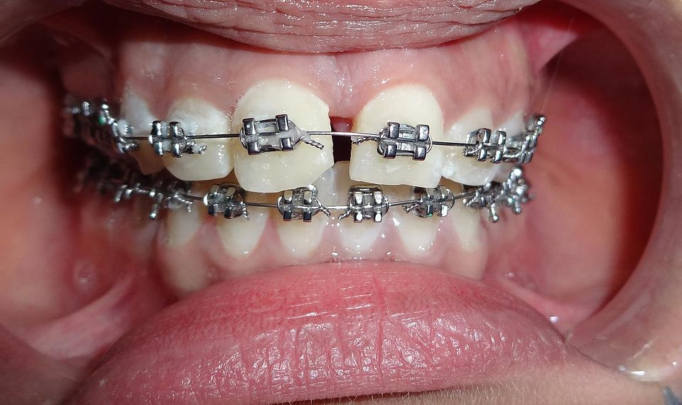 dental braces