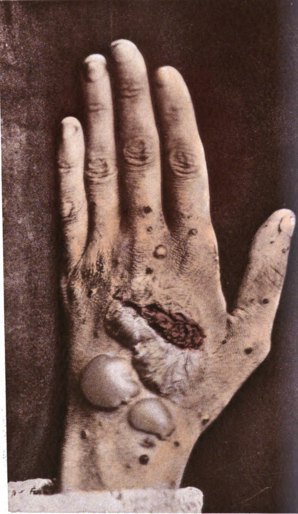 pemphigus