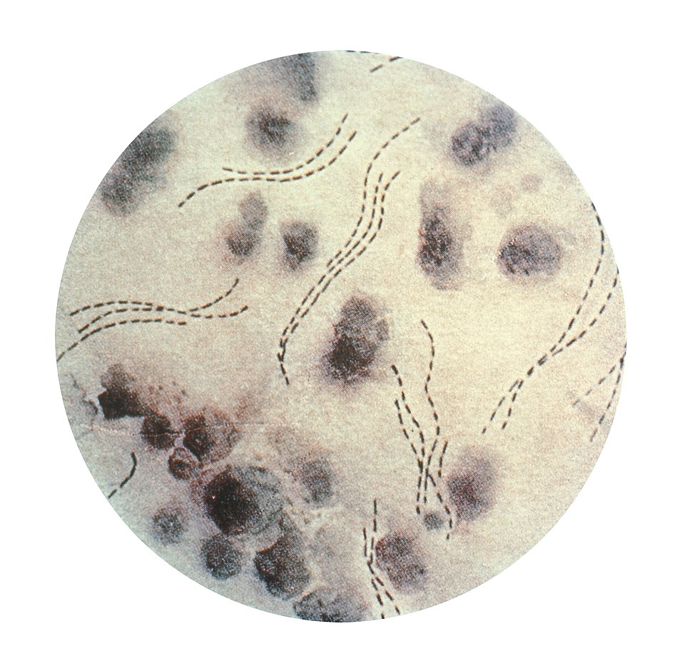 chancroid