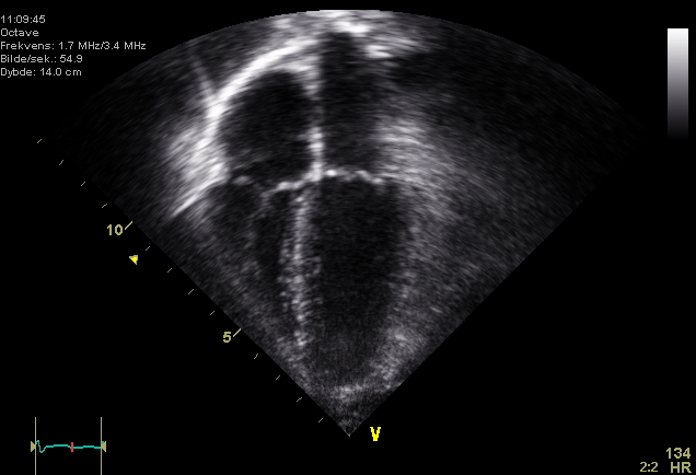 echocardiography