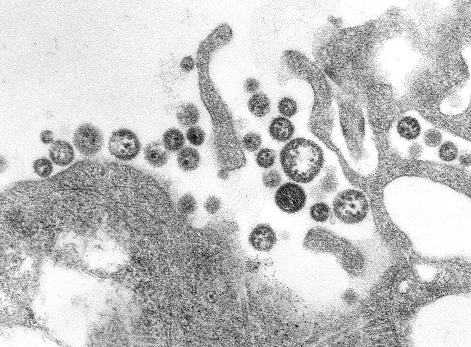 Lassa fever