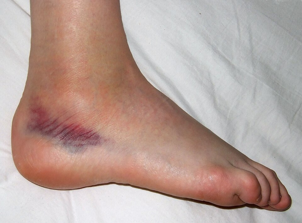 sprain