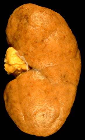 nephritis