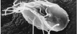 giardiasis