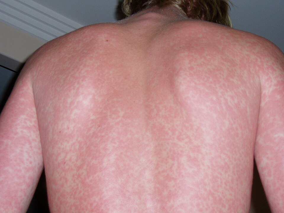 rash