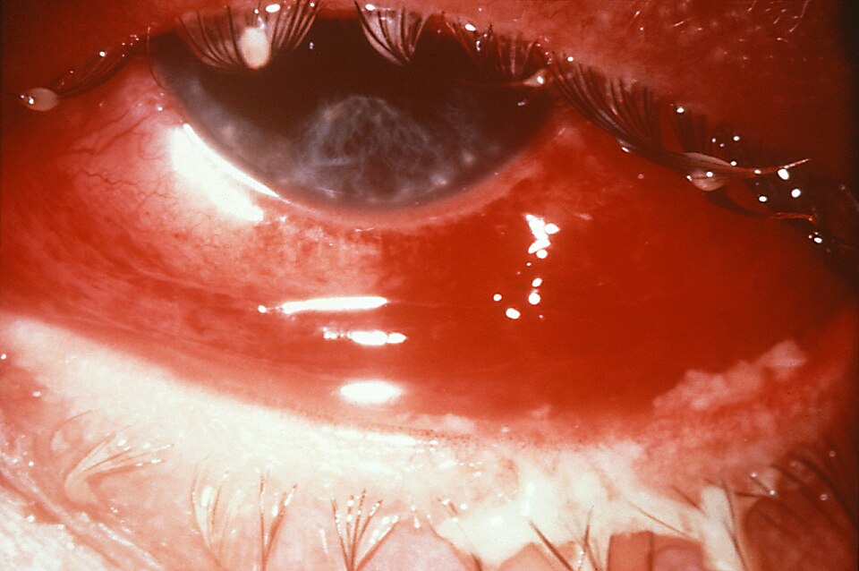 conjunctivitis