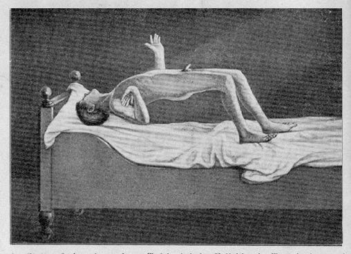 catalepsy
