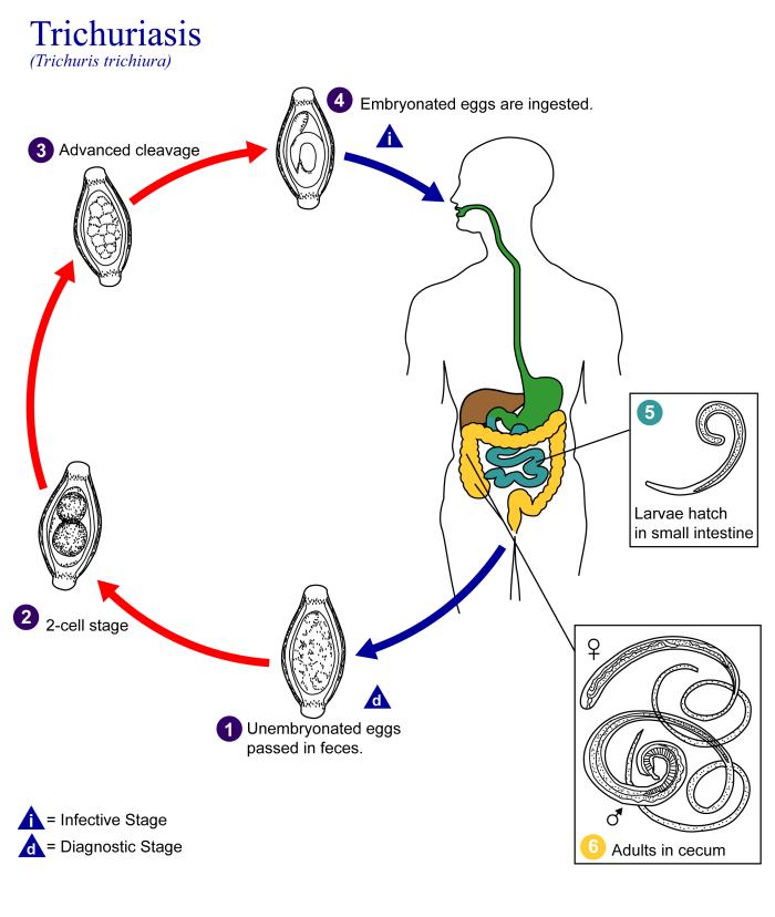 trichuriasis